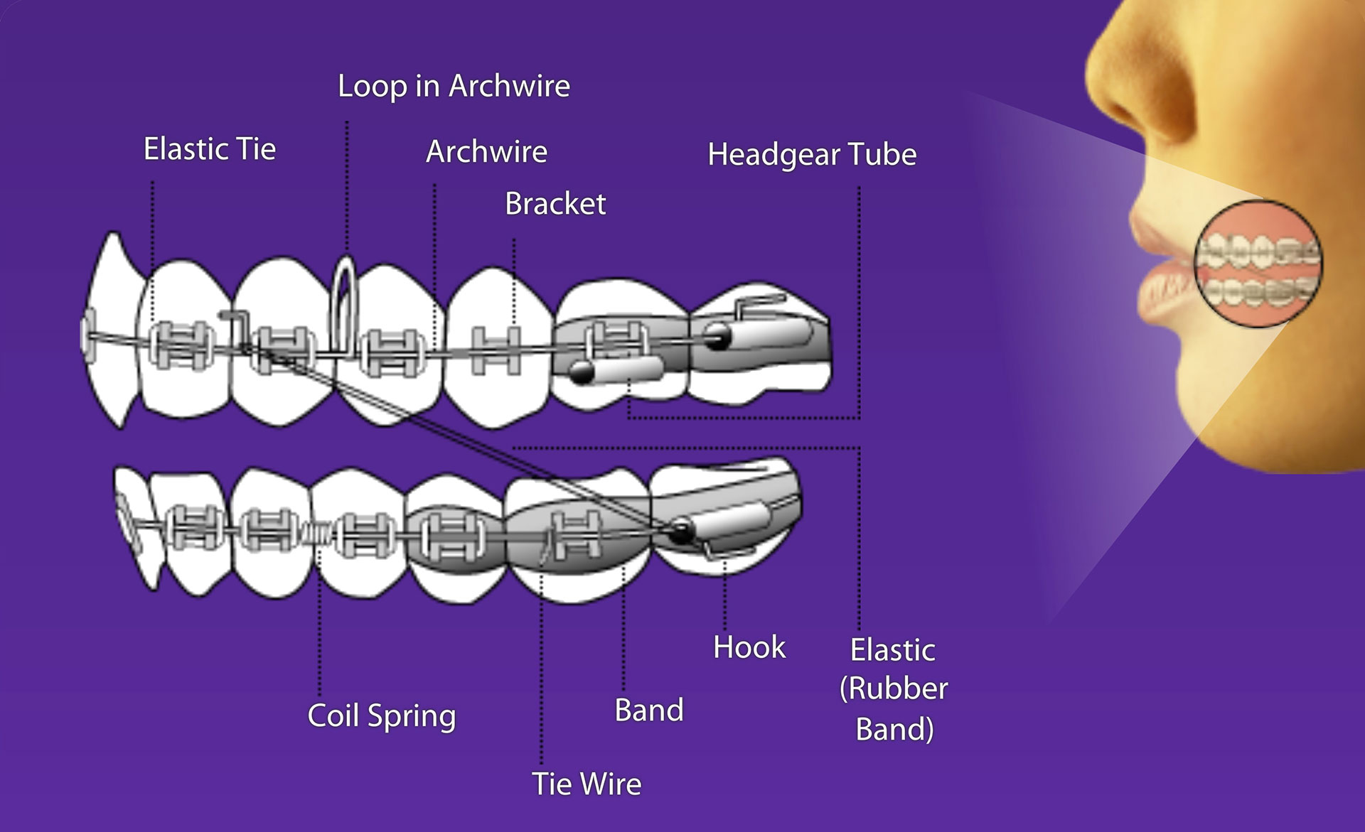 Parts Of Braces How Do Invisible Aligners Work Pros Cons Costs 